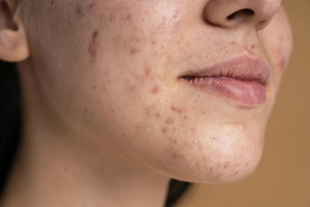 Che differenza c’è tra acne e brufoli?